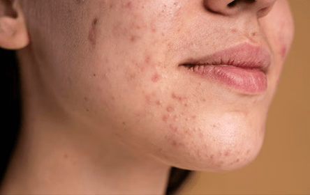 Acne Scars