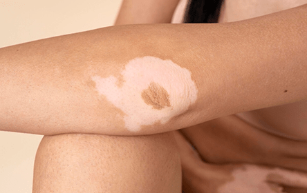 Burn Scars