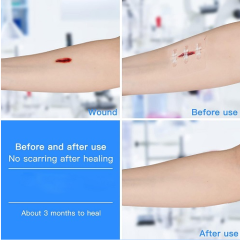 Emergency Wound Closures Device