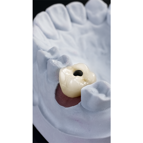 porcelain fused to metal implant crown screw retainer