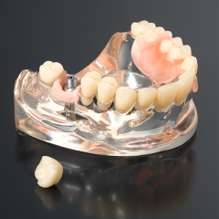 porcelain fused to metal implant crown cemented retainer
