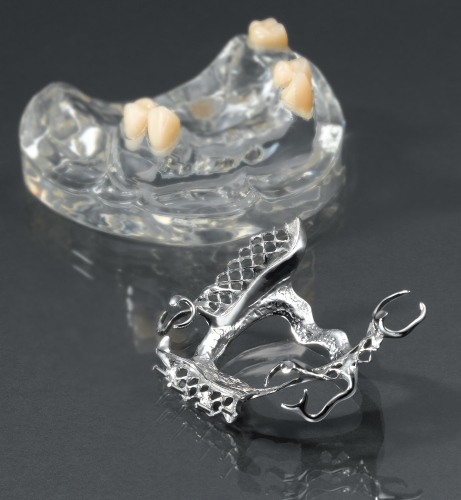 removable upper cast partial