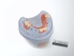 removable-upper acrylic partial denture