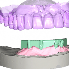 digital design of custom implant bar