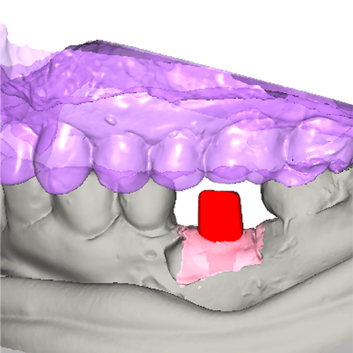 digital design of custom implant abutment
