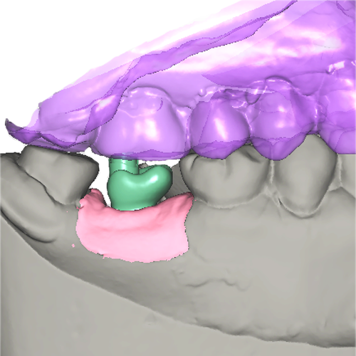 digital design of implant screw retainer