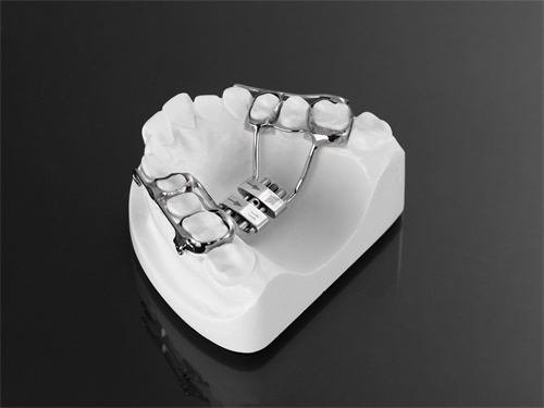 Rapid Palatal Expansion with hooks