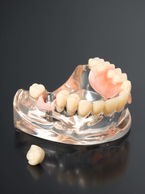 dental crown manufacturer