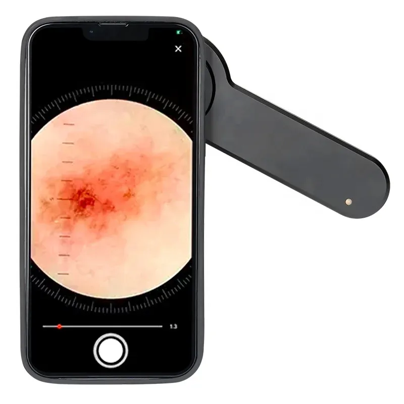 digital dermoscope