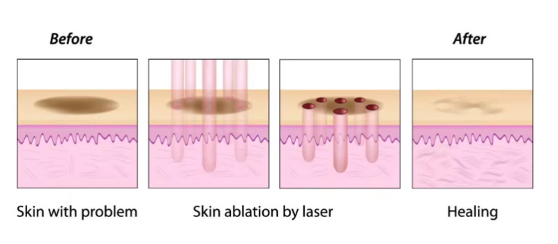 Painless CO2 fractional laser scar removal machine