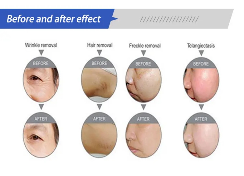 Laser hair removal