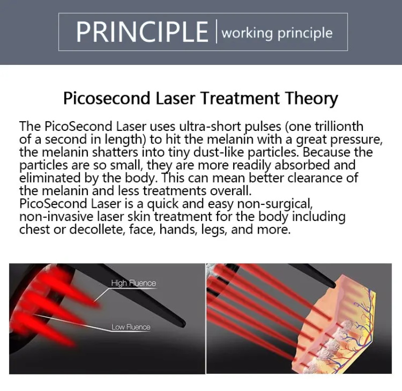 Épilation au laser