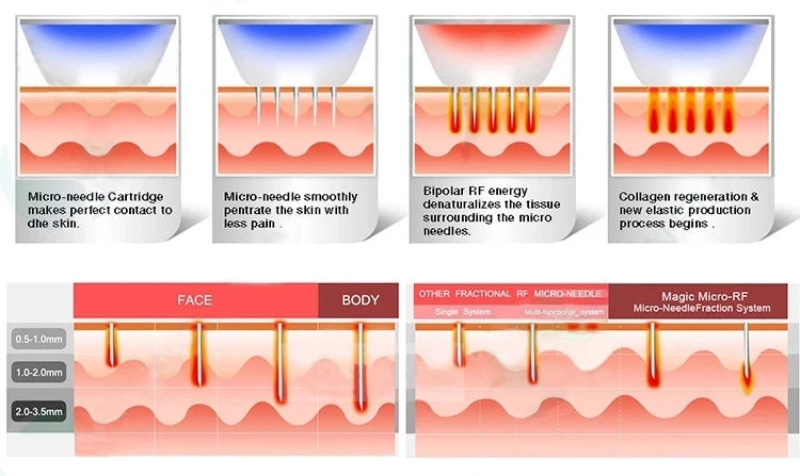 RF fractional microneedle machine