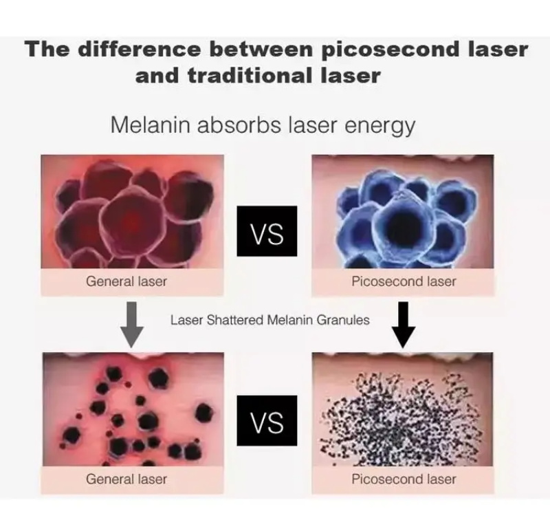 Machine de détatouage au laser picoseconde