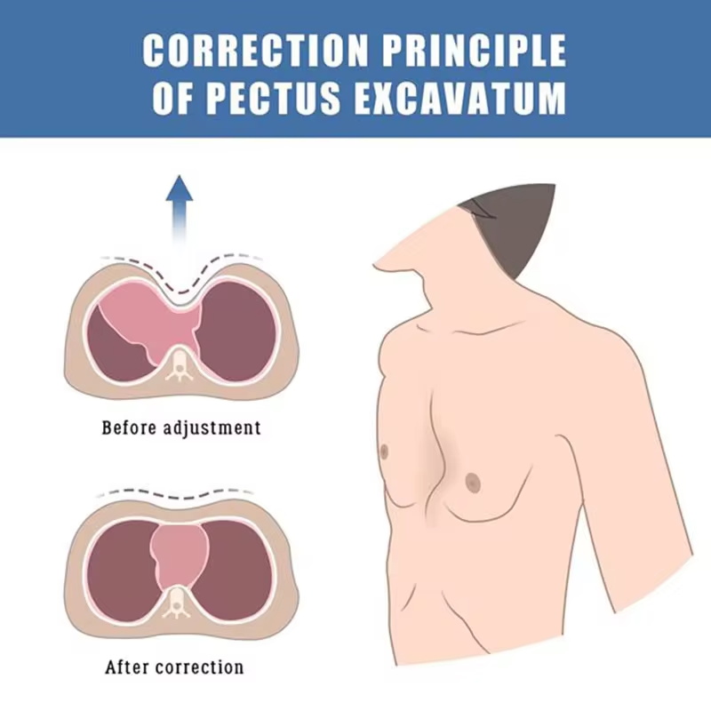 orthèse orthopédique pectus excavatum