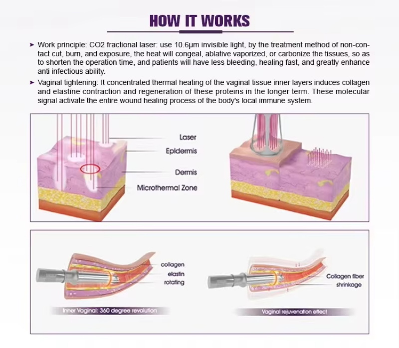 CO2 fractional laser machine