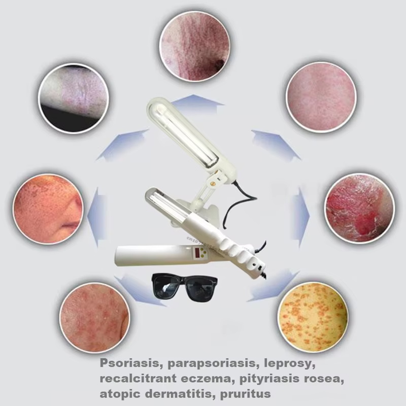 311nm UVB phototherapy narrow