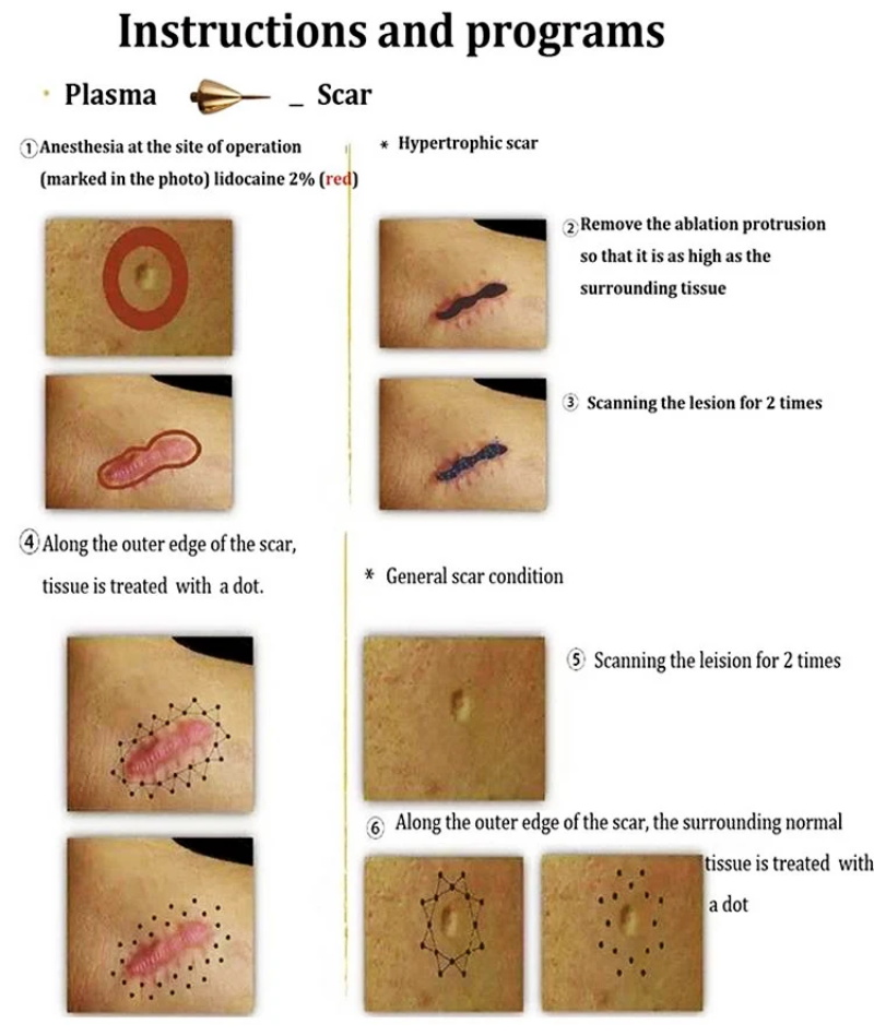 Machine de soins de la peau pour l'élimination des cicatrices d'acné