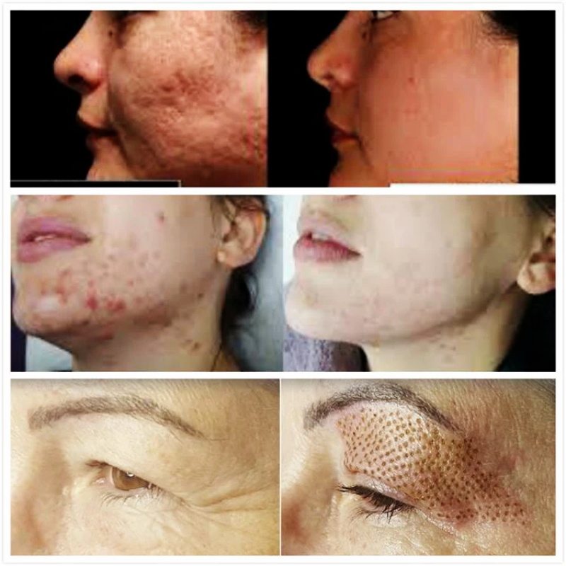 Acne Scar Removal Skin Care Machine