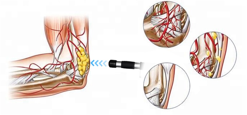 pneumatic shockwave therapy machine