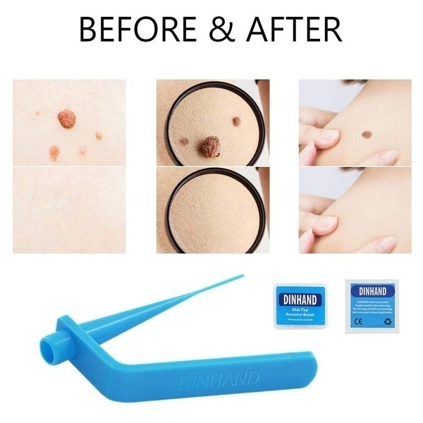 Micro Sets & Skin Tag Remover Device Kit For Small To Medium Skin Tags