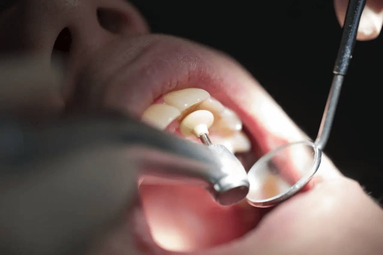 A Beginner's Guide to Dental Polishing Tools