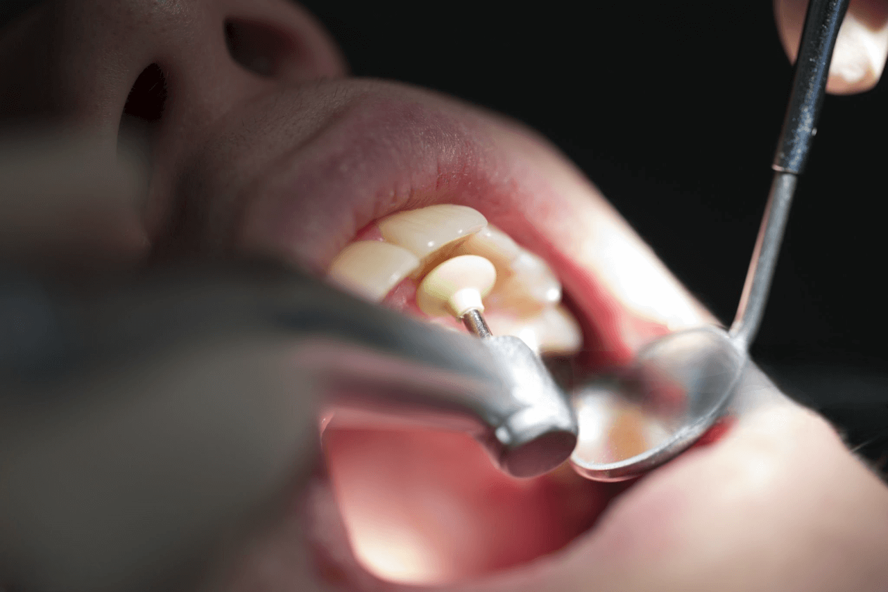 How to Choose the Right Dental Polisher for Your Needs