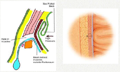 Mesh Biohealth Vector Hernia