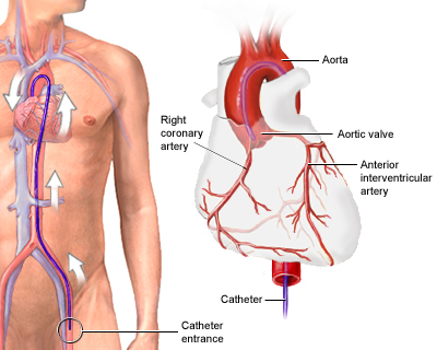 (II)What is Angiography Catheter?