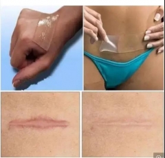 Silicone Scar Patch Customized Effective Healthcare Beauty Safe