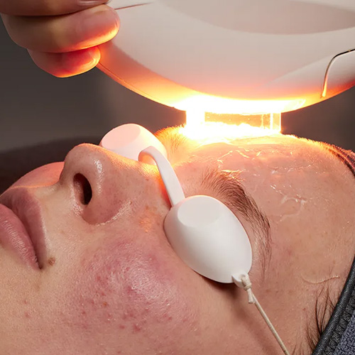 How Does IPL Treat Pigmentation?