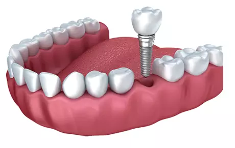 Why dental plants are so expensive in China?