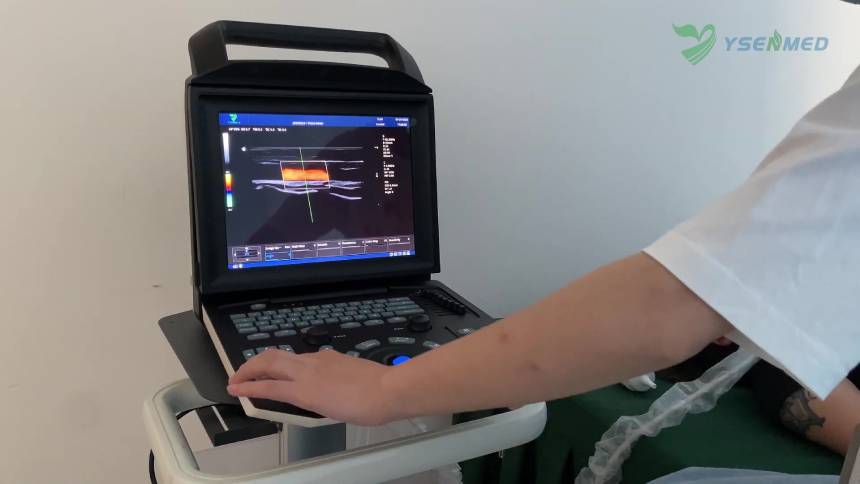 Varredura da tireoide no modo colorido com o sistema portátil de ultrassom doppler colorido YSENMED YSB-M5