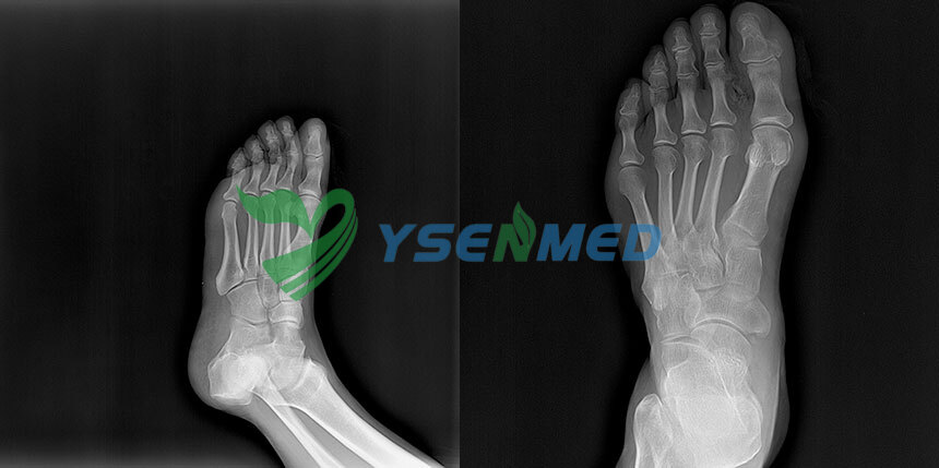 Images radiographiques cliniques exceptionnelles de la cheville grâce au détecteur DR sans fil YSENMED YSFPD-M1717V