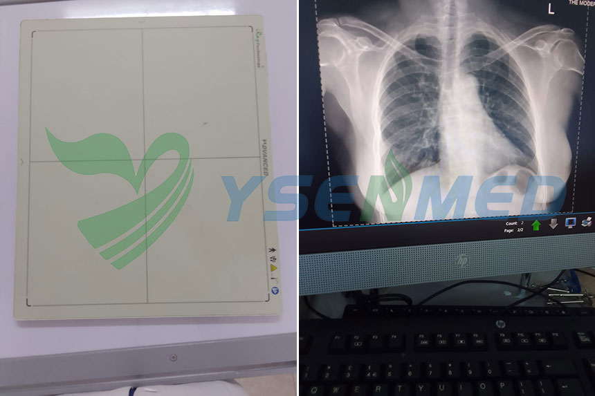 الصور عالية الجودة التي التقطها جهاز الكشف عن اللوحة المسطحة YSFPD-M1717V ترضي الطبيب الكيني