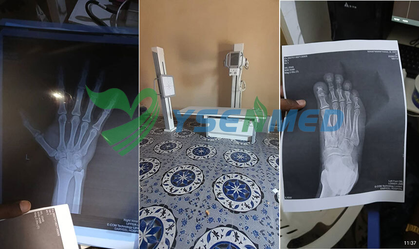 Dr. Xaash from Somalia Chooses YSENMED 32kW Medical Digital X-ray Machine for High-Quality Imaging
