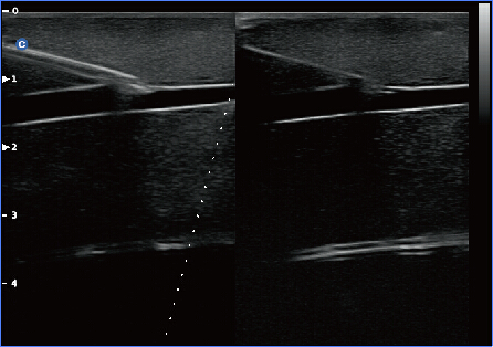 CHISON QBit5 SUPER NEEDLE