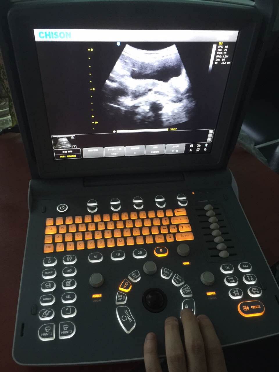 CHISON ECO1 B/W Portable Ultrasound Machine Price