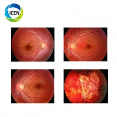 IN-VDER (Model B) Ophthalmology Examination Equipment Desk Top Medical Non Mydriatic Digital Eye Fundus Camera