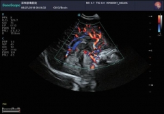 Sonoscape P20 Trolley Medical Echo Machine Color Doppler 3d 4d Ultrasound Scan Machine