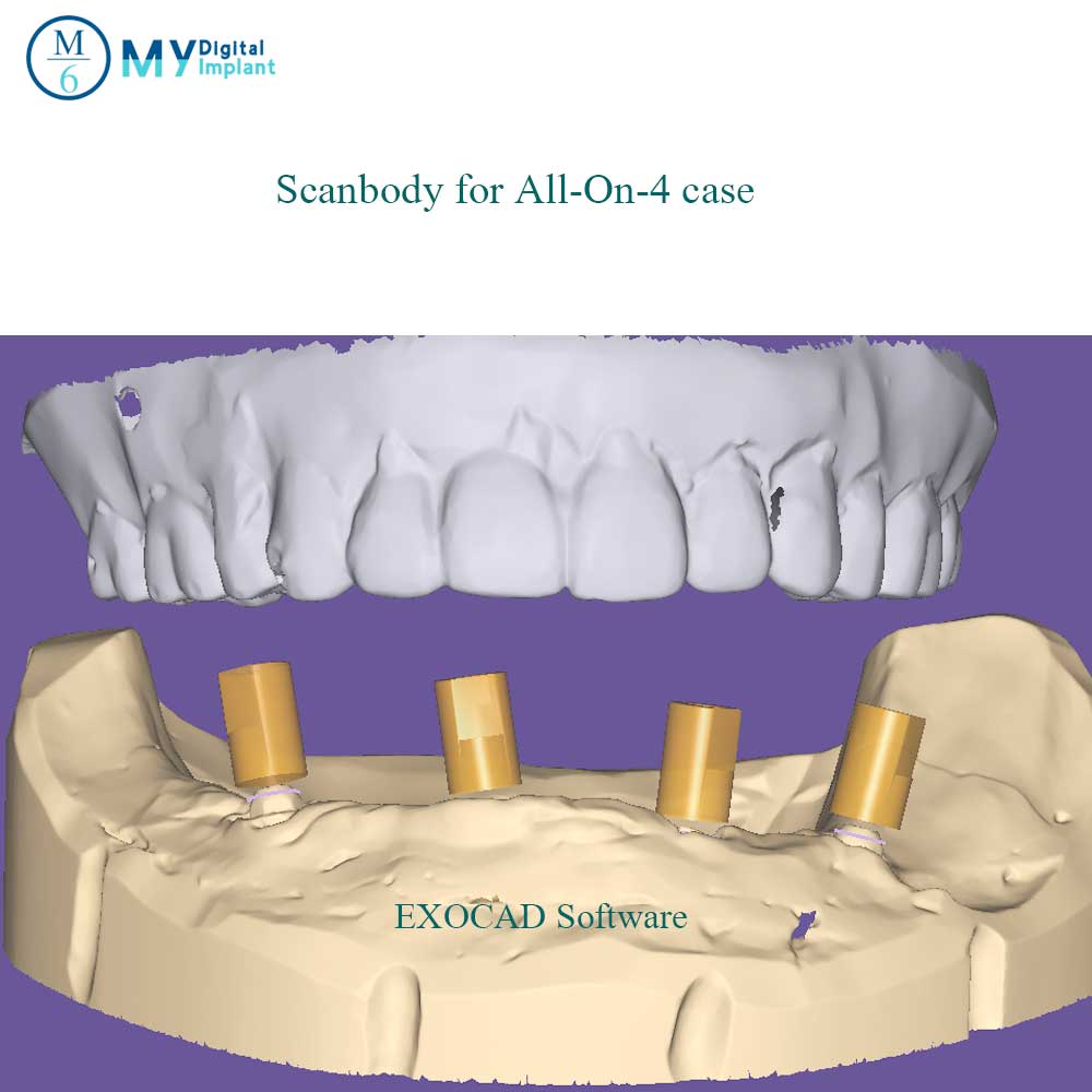 dental implant scan flag in oral