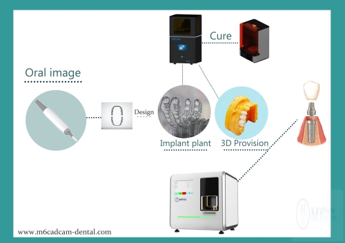 CADCAM Chairside Digital solution work flow from scaning-printing-milling-customized abutment and crown