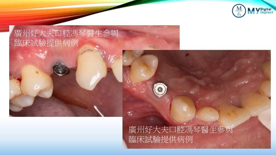 Use AIO abutment to scan in oral