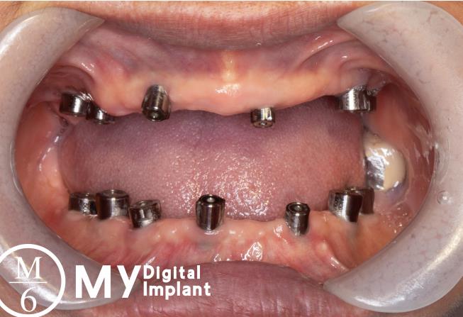 Edentulous implant case with AIO abutment