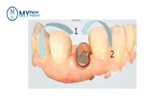 what is digital dental scanbody？