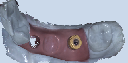 стоматологическое сканирование тела для получения цифрового оттиска