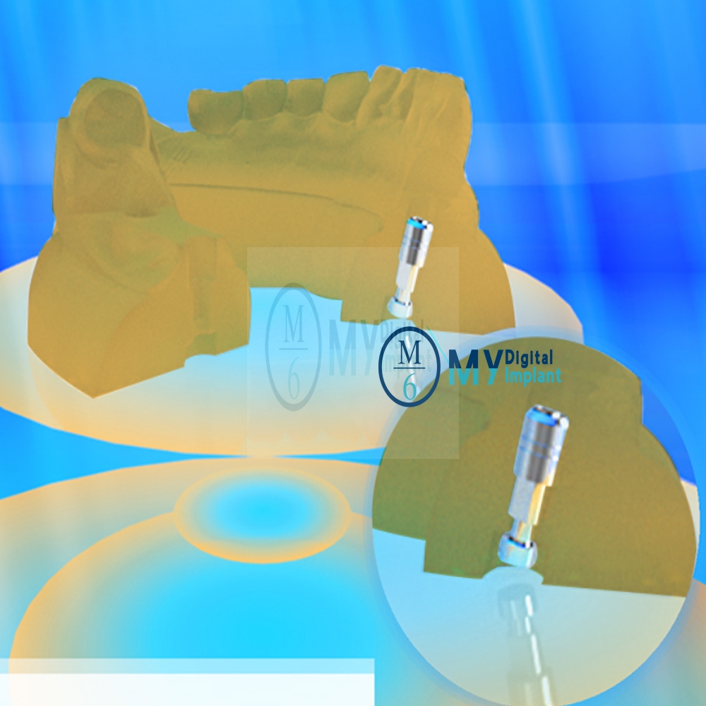digital printed dental model
