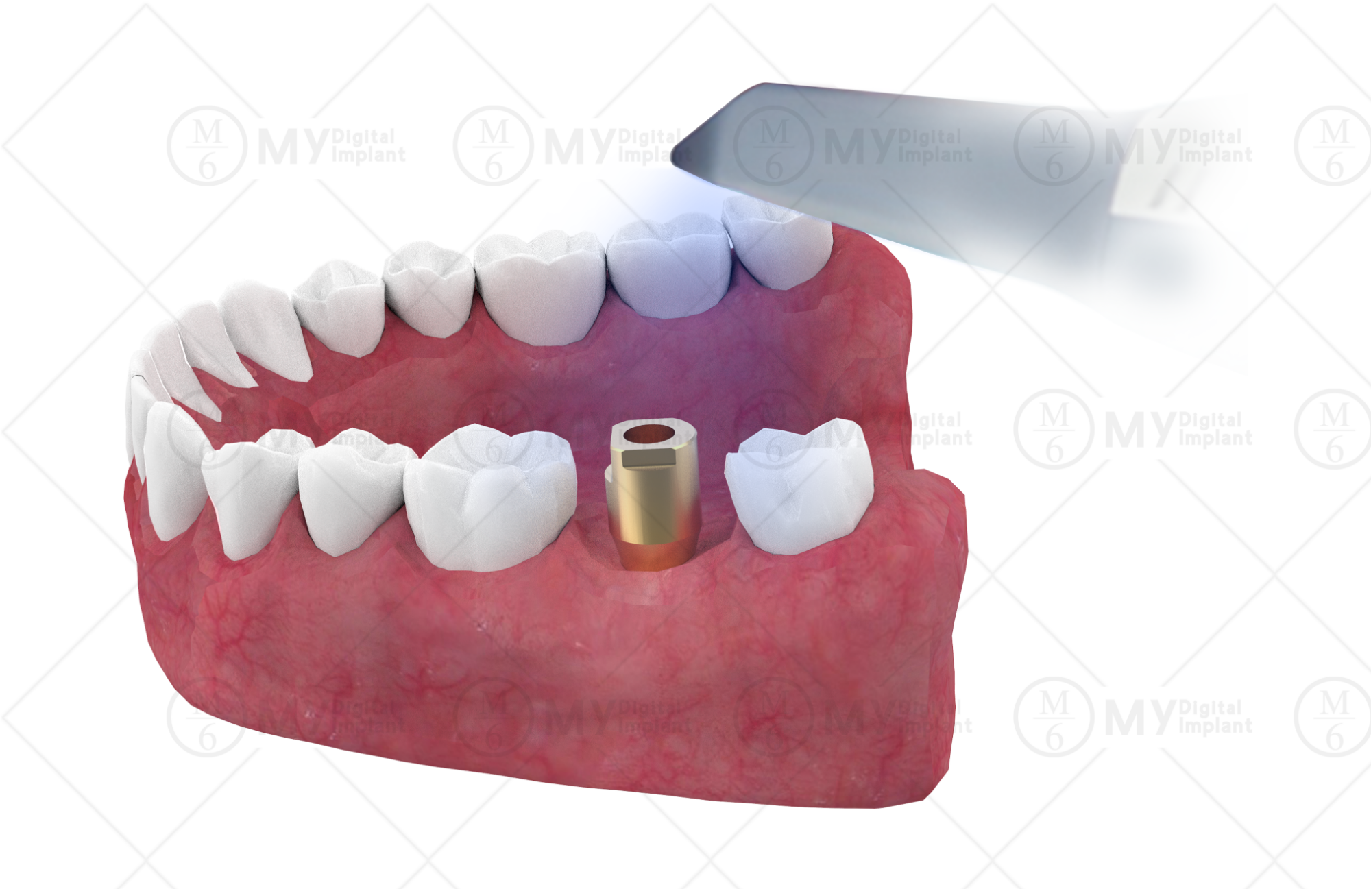 dental impression taking with intra oral scanner