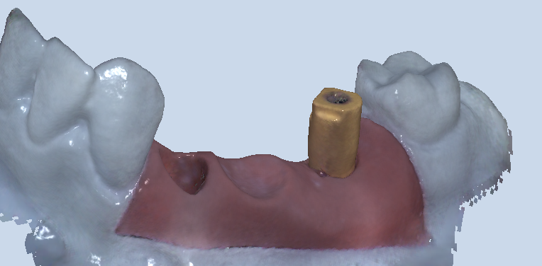 Trụ scan nội bộ được sử dụng trong miệng để lấy dấu răng kỹ thuật số