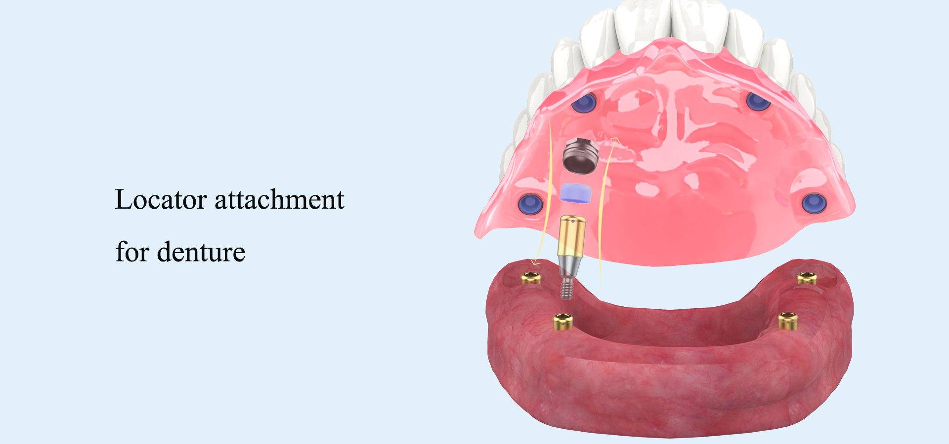 Dental locator abutment